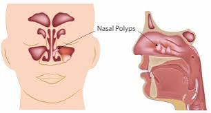 Nasal Blockage